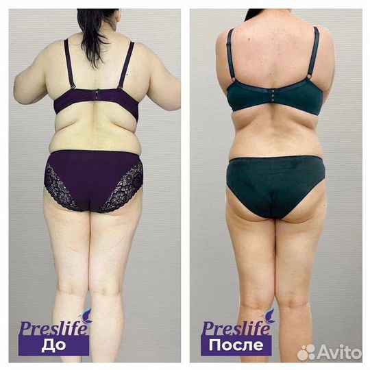 Ищем моделей на подтяжку животика