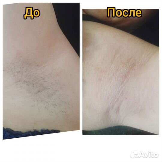 Депиляция