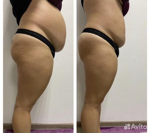 Антицеллюлитный массаж ручной