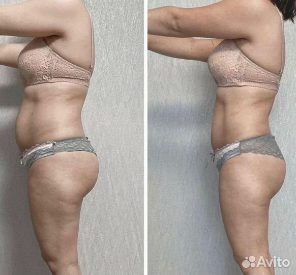 Модель на криолиполиз