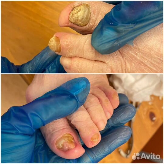 Подолог,медицинский педикюр, SMART педикюр