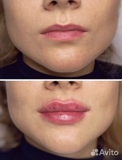 Косметология / ботокс / увеличение губ