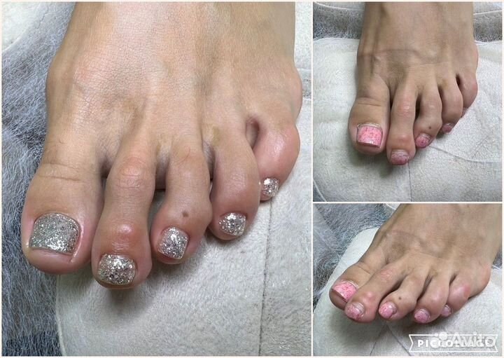 Медицинский педикюр