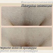 Лазерная эпиляция/Шугаринг/Восковая депиляция, Энгельс