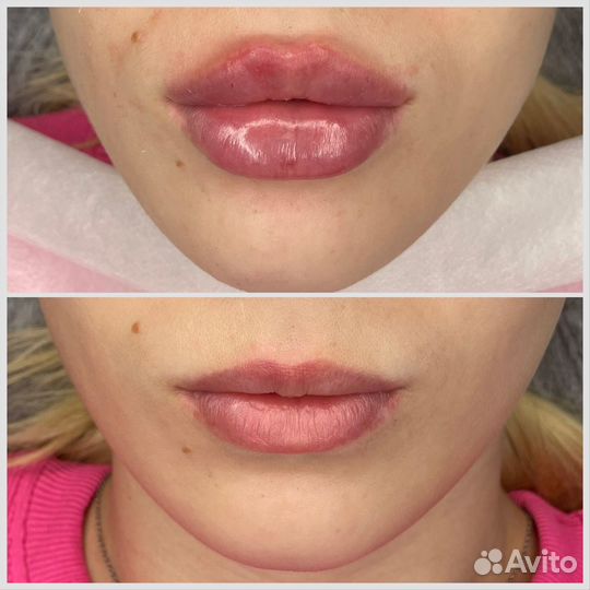Коррекция губ, увеличение губ