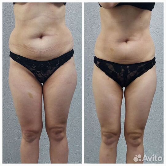 Коррекция фигуры - эффективное похудение