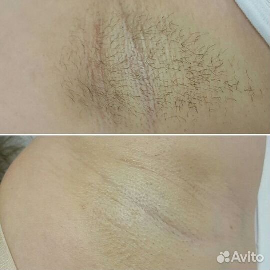 Удаление волос