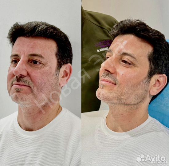 Подтяжка лица за одну процедуру. Альтератерапия