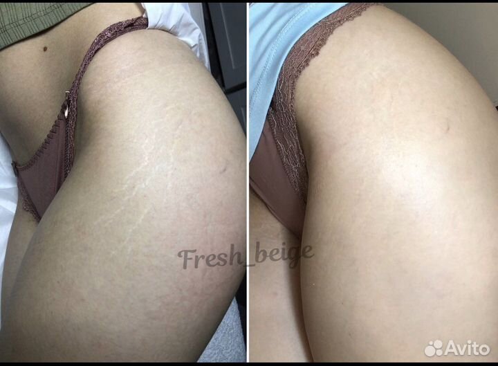 Татуаж растяжек и шрамов