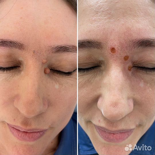 Удаление новообразований без шрамов и без боли