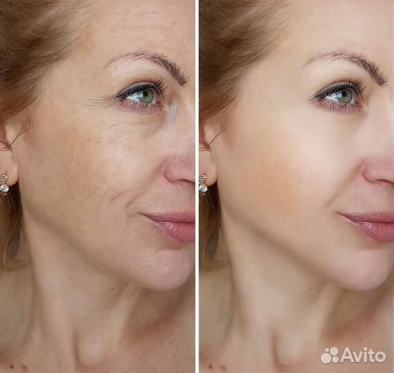 Безоперационная подтяжка лица, РФ лифтинг