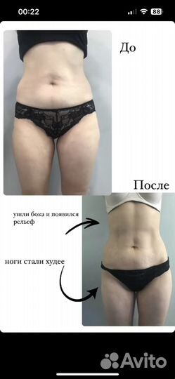 Похудение, Миостимуляция, Kоррекция фигуры