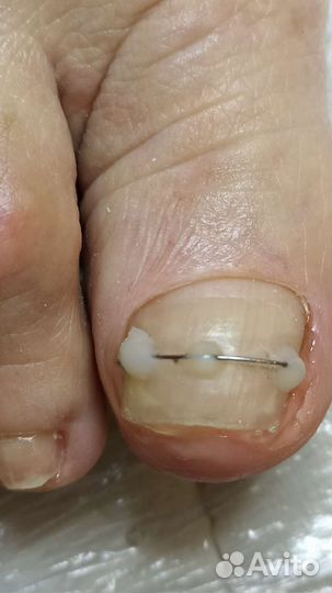 Медицинский педикюр, педикюр