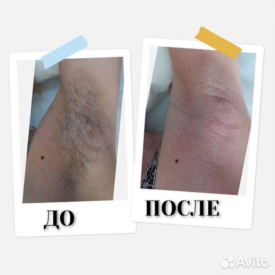 Депиляция воск/сахар
