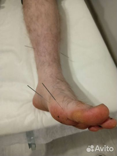 Акупунктура