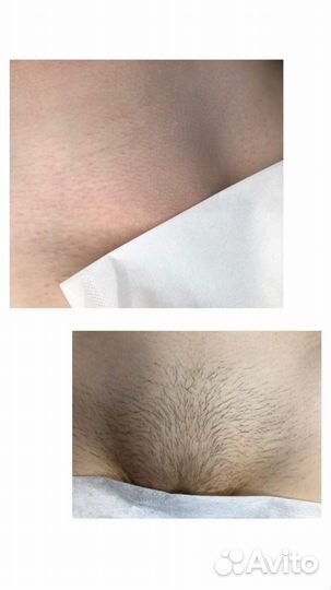 Депиляция воском