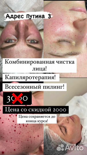 Капиляротерапия