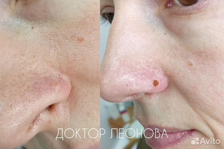 Удаление родинок папиллом у дерматолога