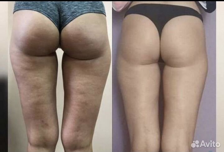 Антицеллюлитный массаж и коррекция фигуры