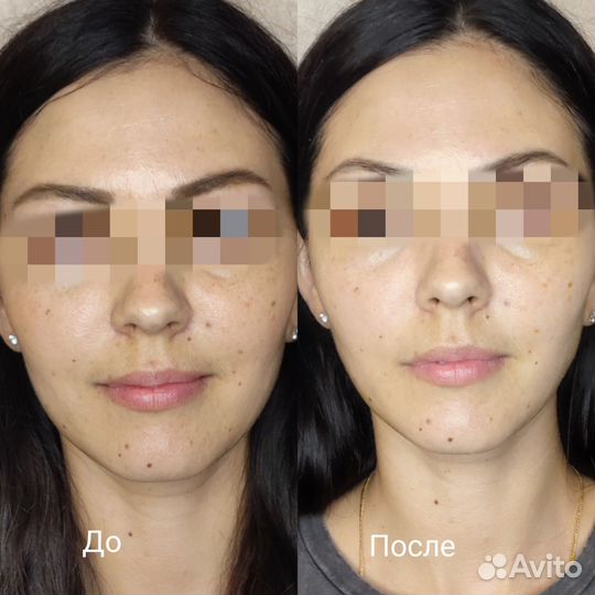 Кавитация Rf лифтинг Вакуум