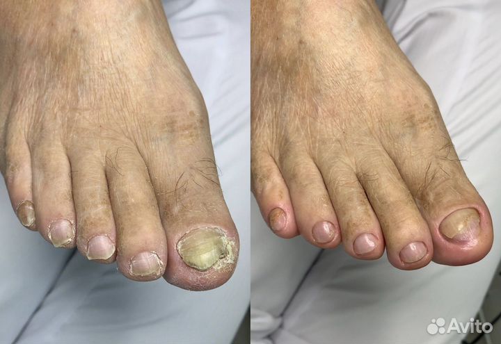 Медицинский педикюр подолог