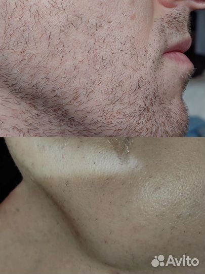 Электроэпиляция