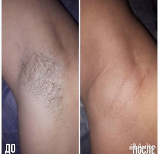 Лазерная эпиляция, элос эпиляция, элос омоложение