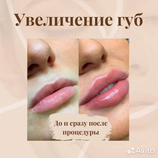 Увеличение губ