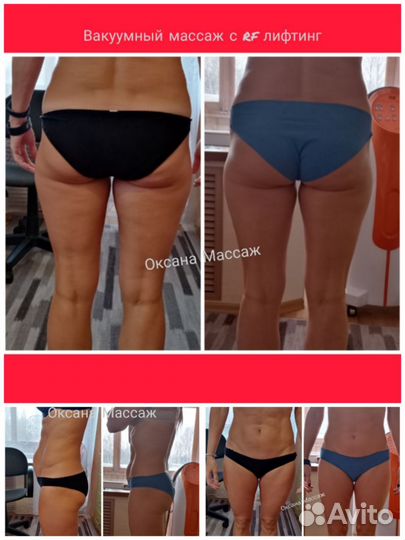 Массаж антицеллюлитный, аппаратный, спины и ШВЗ