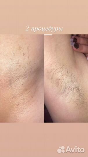 Электроэпиляция