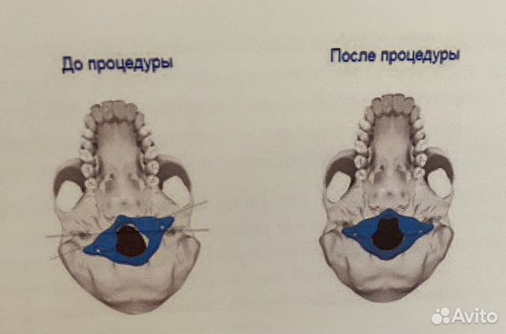Коррекция первого шейного позвонка атланта