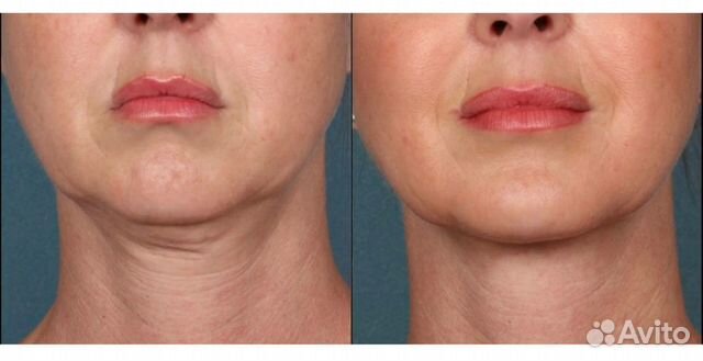 Mesosculpt c71 отзывы фото до и после Аппаратный массаж.Криолиполиз второго подбородка в Йошкар-Оле Услуги Авито
