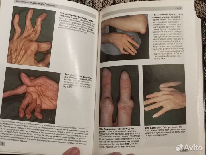 Симптомы внутренних болезней, М. Затурофф
