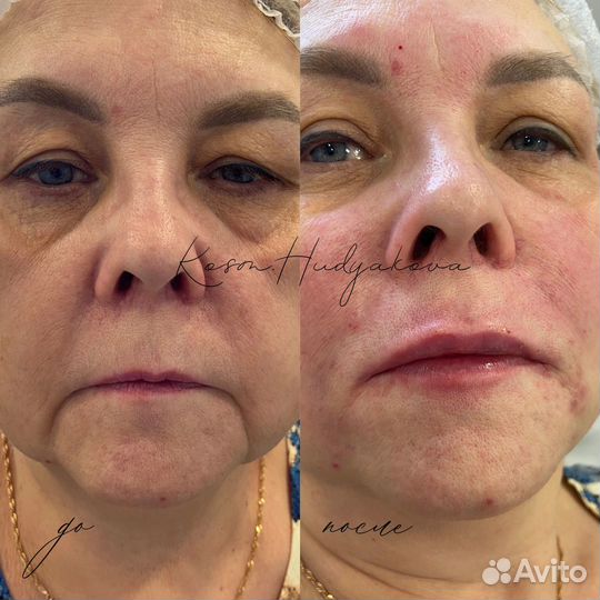 Заполнение носогубных складок