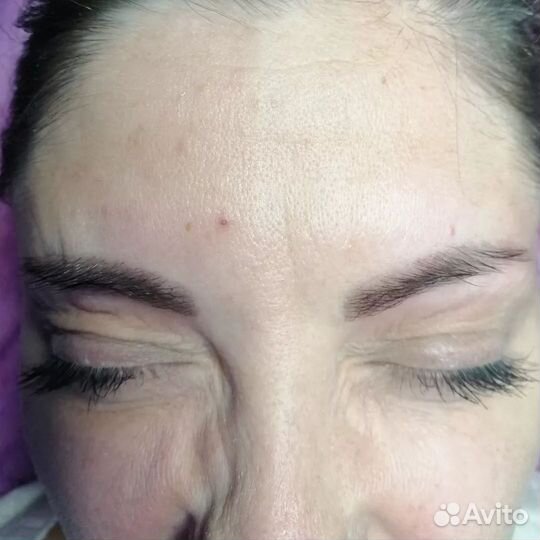 Ботокс для лица плюс коррекция бесплатно