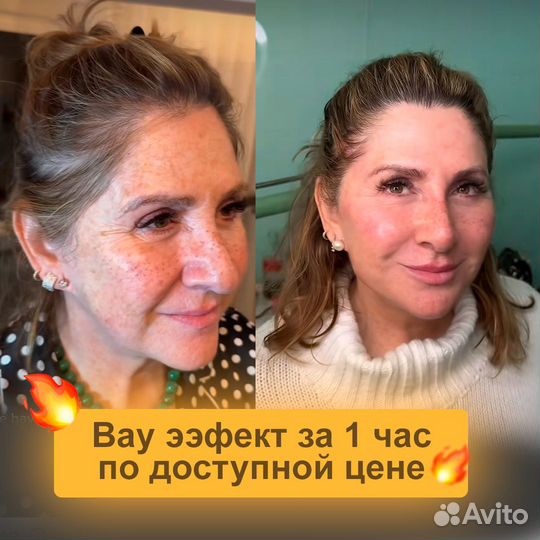 Реструктуризация лица. Нити. Омоложение лица