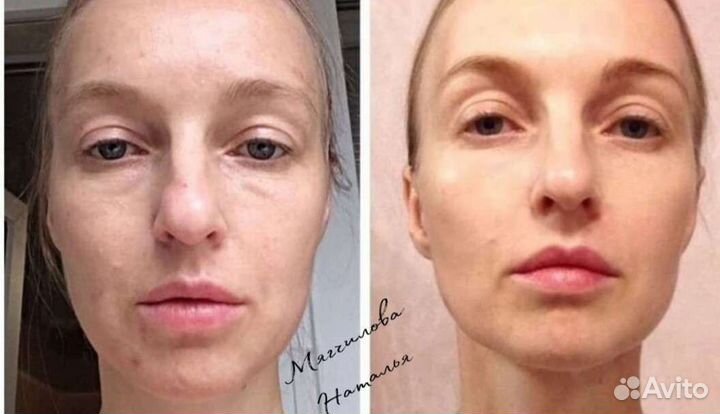 Массаж Антицеллюлитный,Лимфодренажный