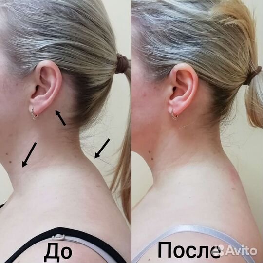 Витапластика