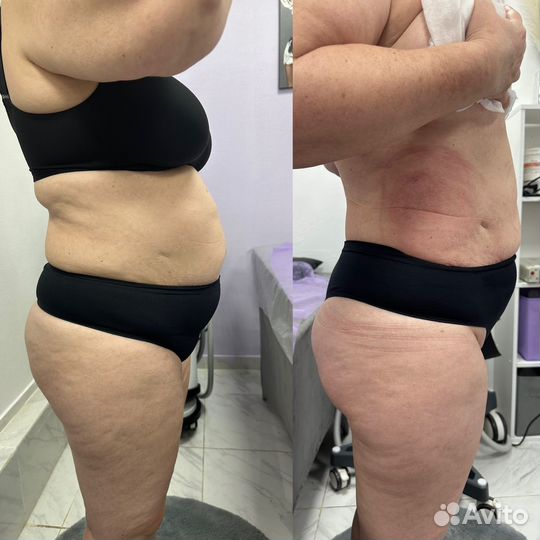 Аппаратная коррекция фигуры