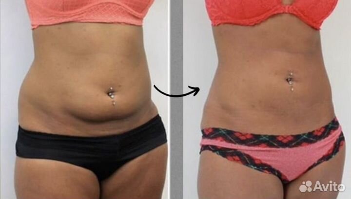 Электромагнитная стимуляция пресса (emsculpt)