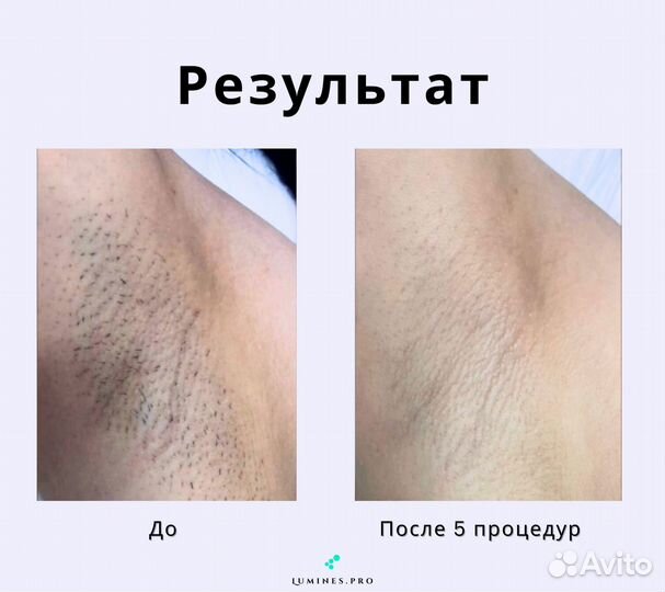 Диодный лазер для эпиляции Lumines Max One 1200