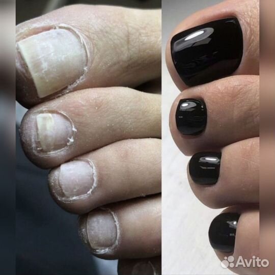 Педикюр, Смарт-Педикюр