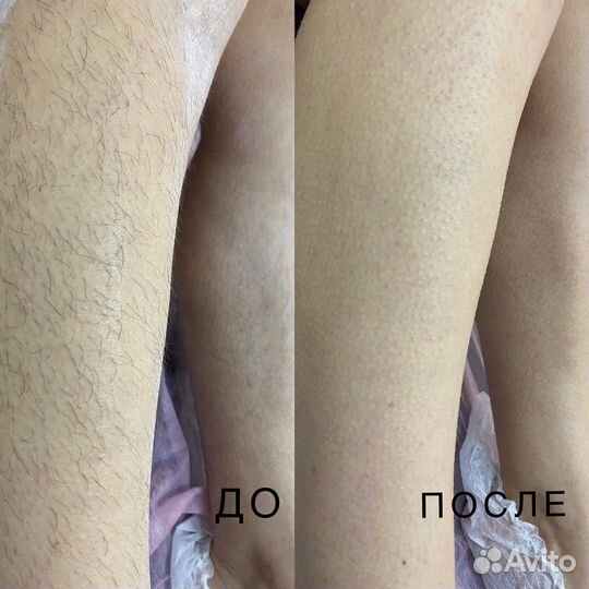 Шугаринг: глубокое бикини