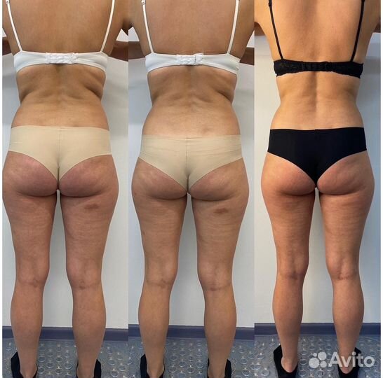 Антицеллюлитный массаж