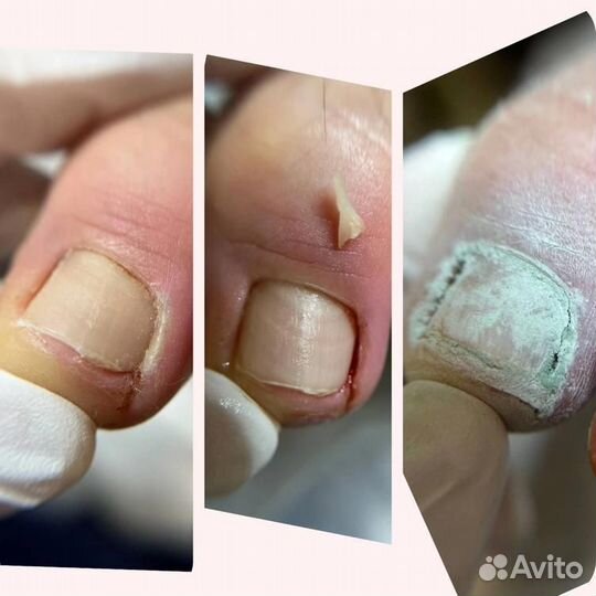 Вросший ноготь коррекция