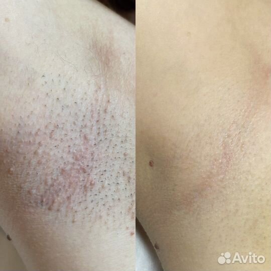 Лазерная эпиляция