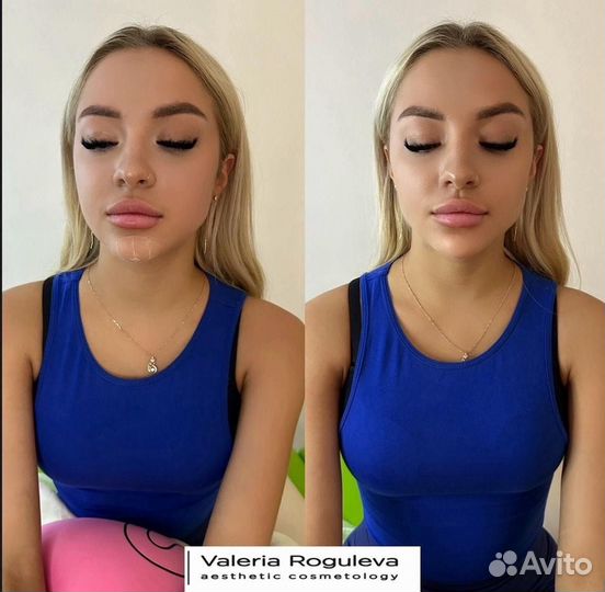 Модель на увеличение губ