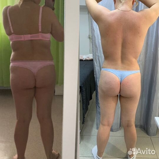 Массаж тела LPG / LPG лица/ мадеротерапия