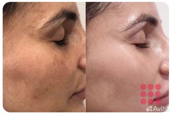Массаж лица и омоложение без уколов и операций
