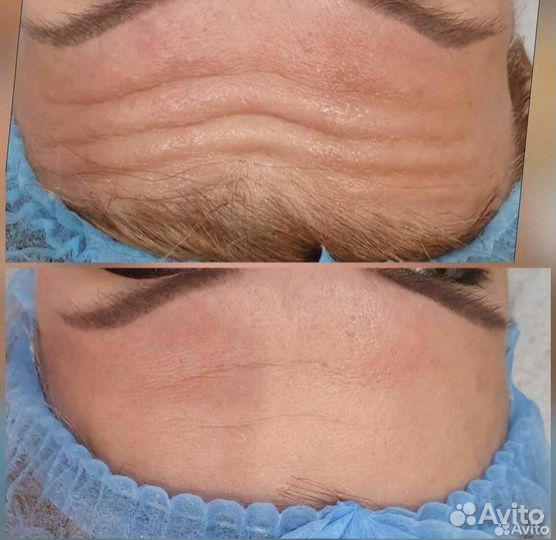 Ботокс для лица